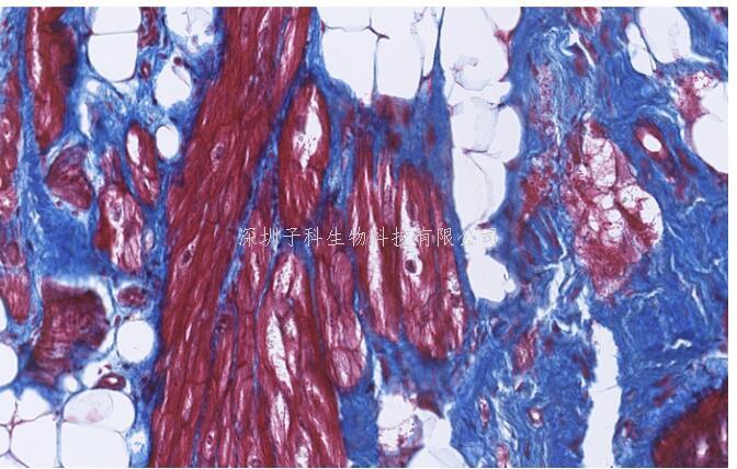 橋粒蛋白分解是心臟病的潛在機(jī)制